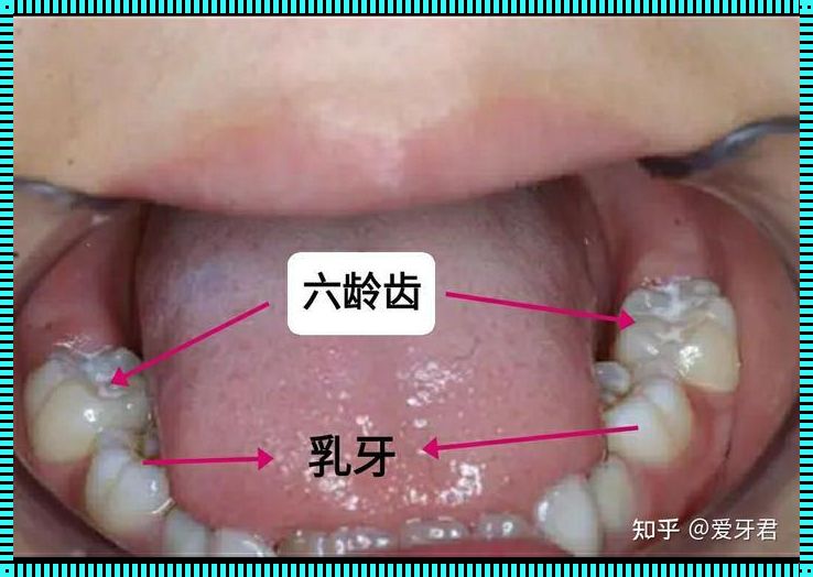 六龄齿受损，儿童口腔健康如何保卫战