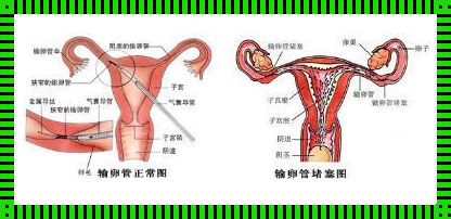 《输卵管堵塞自查与防范：教你识破奥秘》