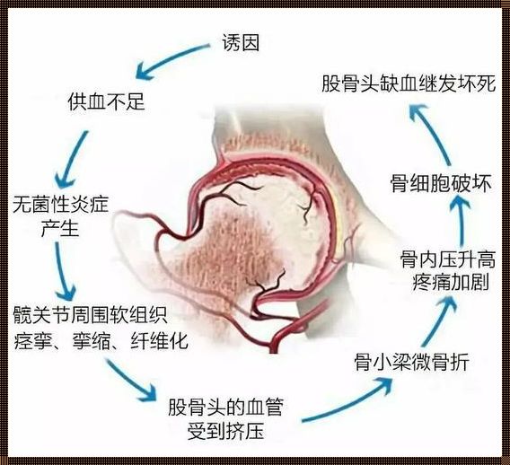 股骨头坏死早期治愈之道：探寻 Effective 疗法