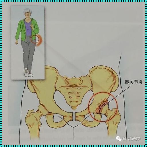 一侧髋关节疼痛的治疗之道：寻求平衡、标本兼治