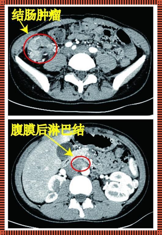 恶性肿瘤扩散之困：肠系膜多发转移