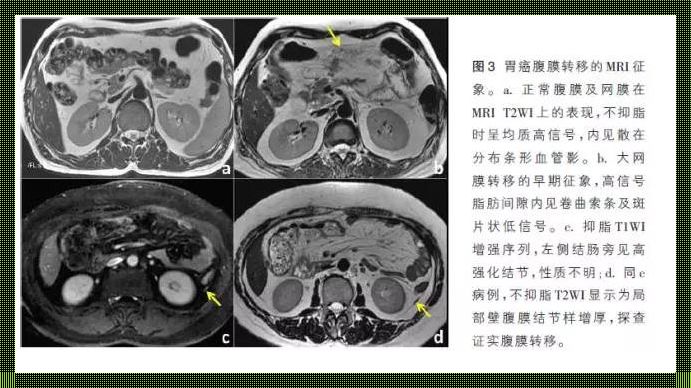 恶性肿瘤扩散之困：肠系膜多发转移