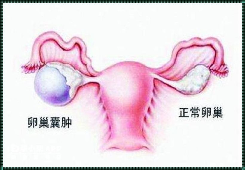 卵巢囊肿的10个征兆：备孕路上的隐形障碍