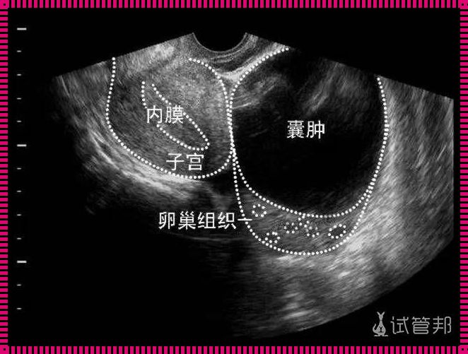 卵巢囊肿多大转为癌变？备孕妈妈惊现良性肿瘤，如何应对？