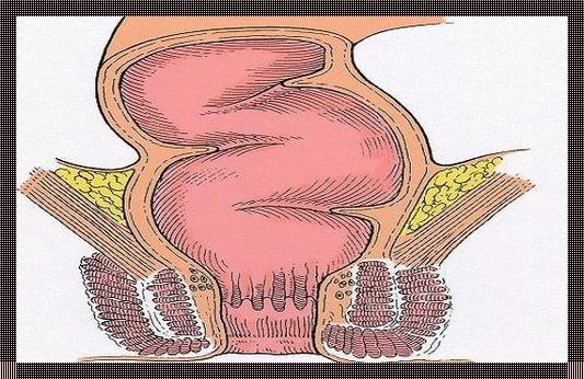肛门癌能保住肛门吗？惊现医学奇迹！