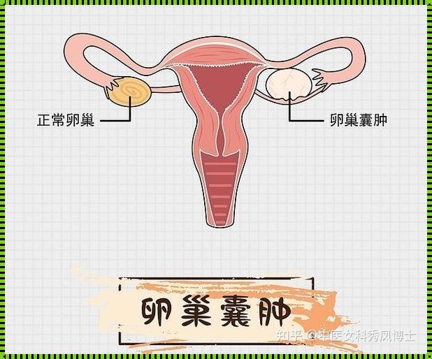 《卵巢囊肿：备孕女性的隐形困扰》