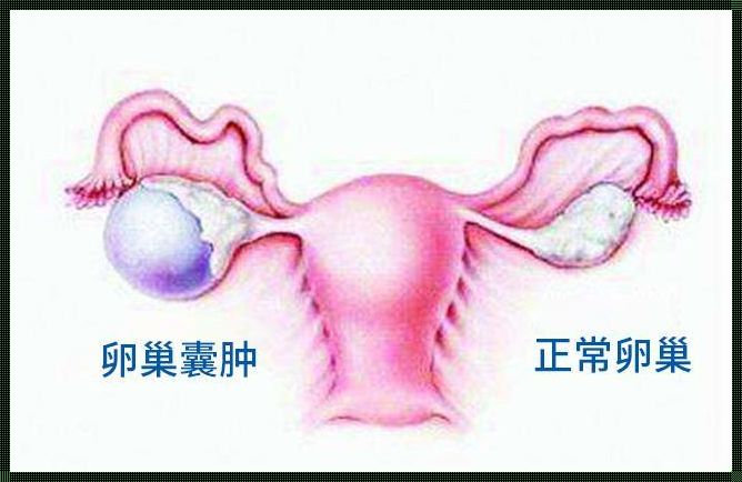 卵巢囊肿：生气真的会导致吗？