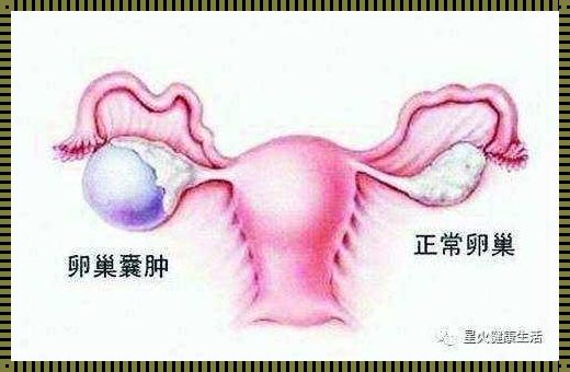 《右卵巢囊肿：探秘病因与备孕困扰》