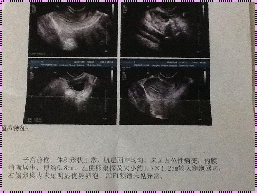 卵巢纤细分隔：备孕路上的惊与喜