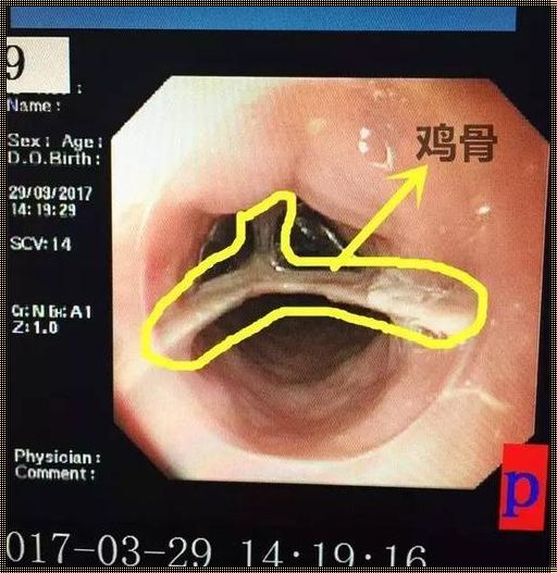 鸡骨头卡食道：意外的隐患与明智的预防