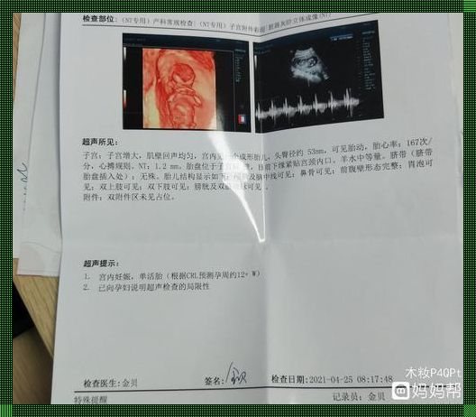 怀孕12周NT检查胎心170次/分钟：正常还是异常？