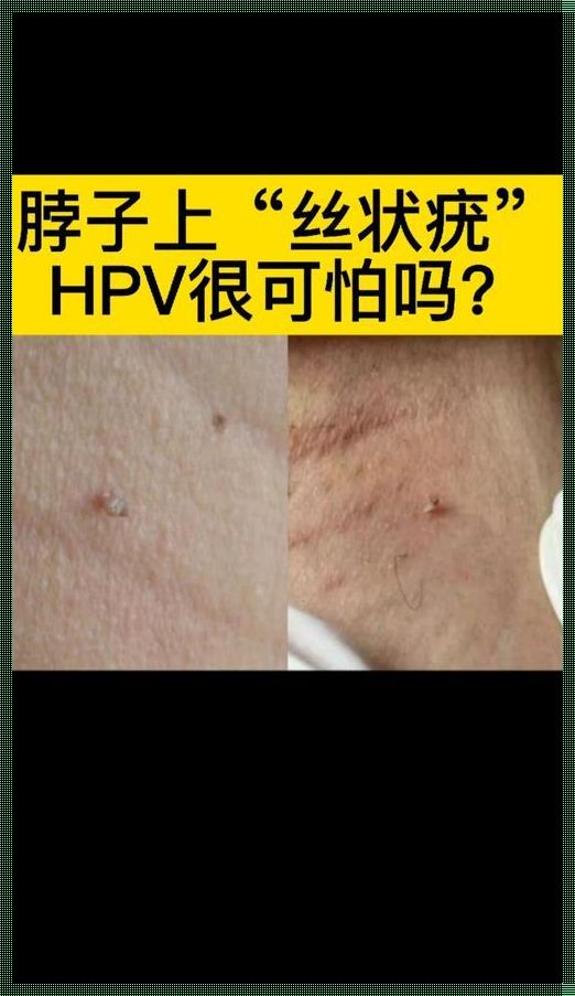 HPV痘痘：揭秘美丽背后的隐忧