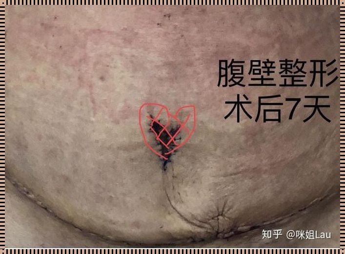 剖腹产后小肚子大一坨：揭秘产后恢复的心得体会