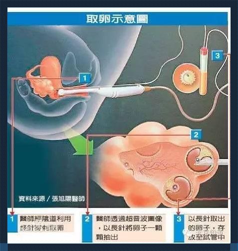 备孕期间，如何寻找合适的卵子捐赠者？