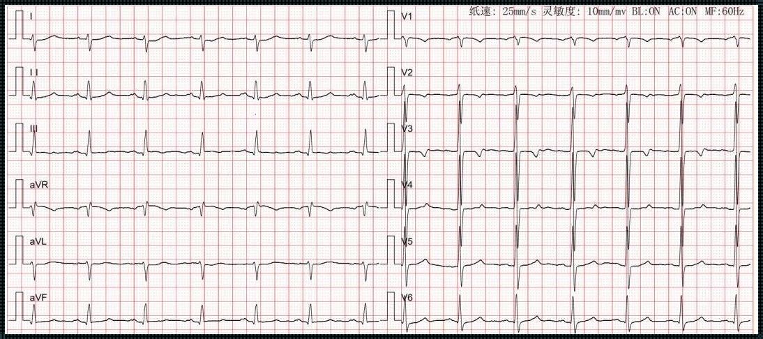 心电轴右偏：正常还是异常？一个生动的探索之旅
