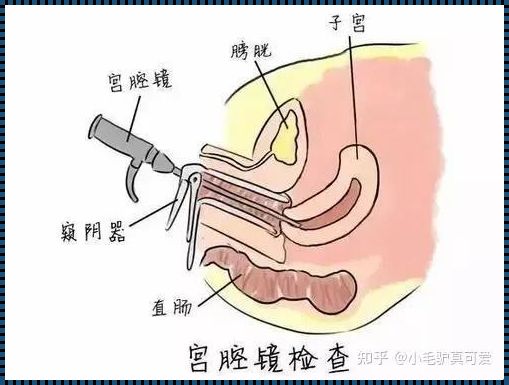 引产后如何防止宫腔粘连？一位母亲的梦幻忧虑之旅