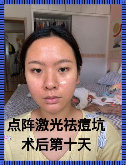 激光祛痘印怎么收费：美容行业的调查