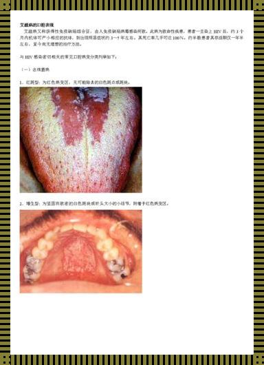 艾滋病早期口腔表现的观察与分析