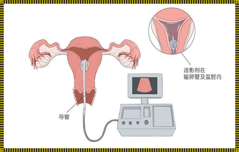 探讨输卵管造影对女性健康的潜在影响及预防措施