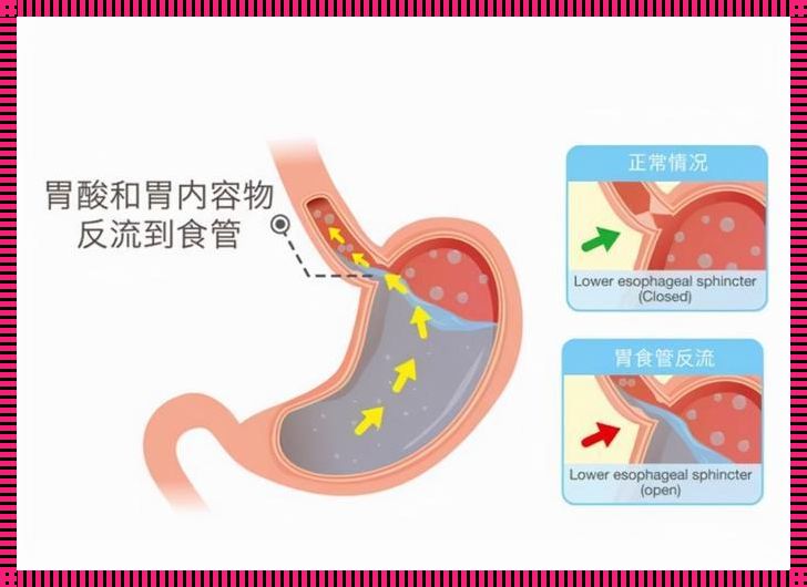 胃食管反流的主要症状——不容忽视的健康警示