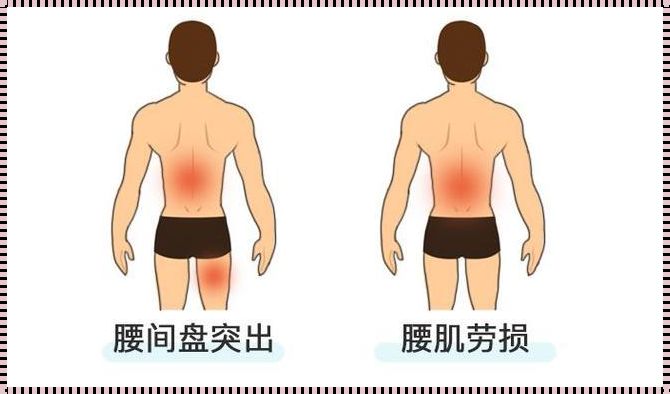 腰肌劳损最忌讳什么？深入探讨与预防策略