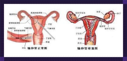 当输卵管堵塞成为备孕路上的拦路虎，我们该如何应对？