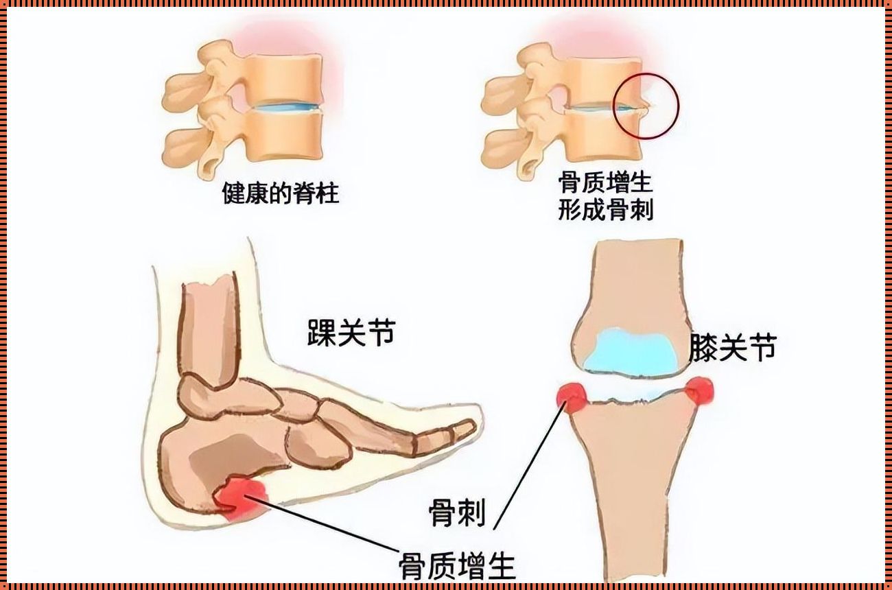 骨刺行走记——探秘骨刺能否被磨没之谜