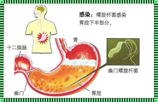 探究食道反流与幽门螺杆菌之间的潜在联系——紧张情绪的来源