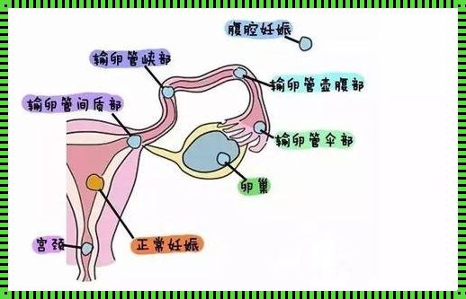 警惕！输卵管妊娠的常见原因及预防策略