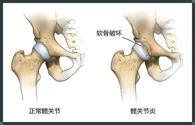 《髋关节炎：一场与时间的较量》