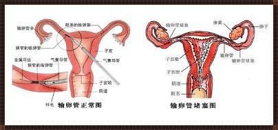 如何识别输卵管堵塞：备孕过程中的挑战与应对策略