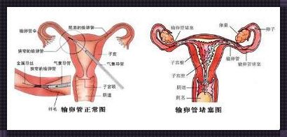 输卵管堵塞的并发症：不容忽视的健康隐患