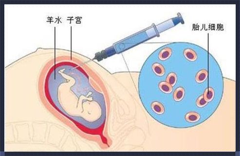 羊膜穿刺引产后需要清宫吗？