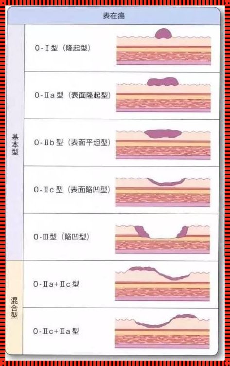 胃癌Lauren分型及特点揭秘