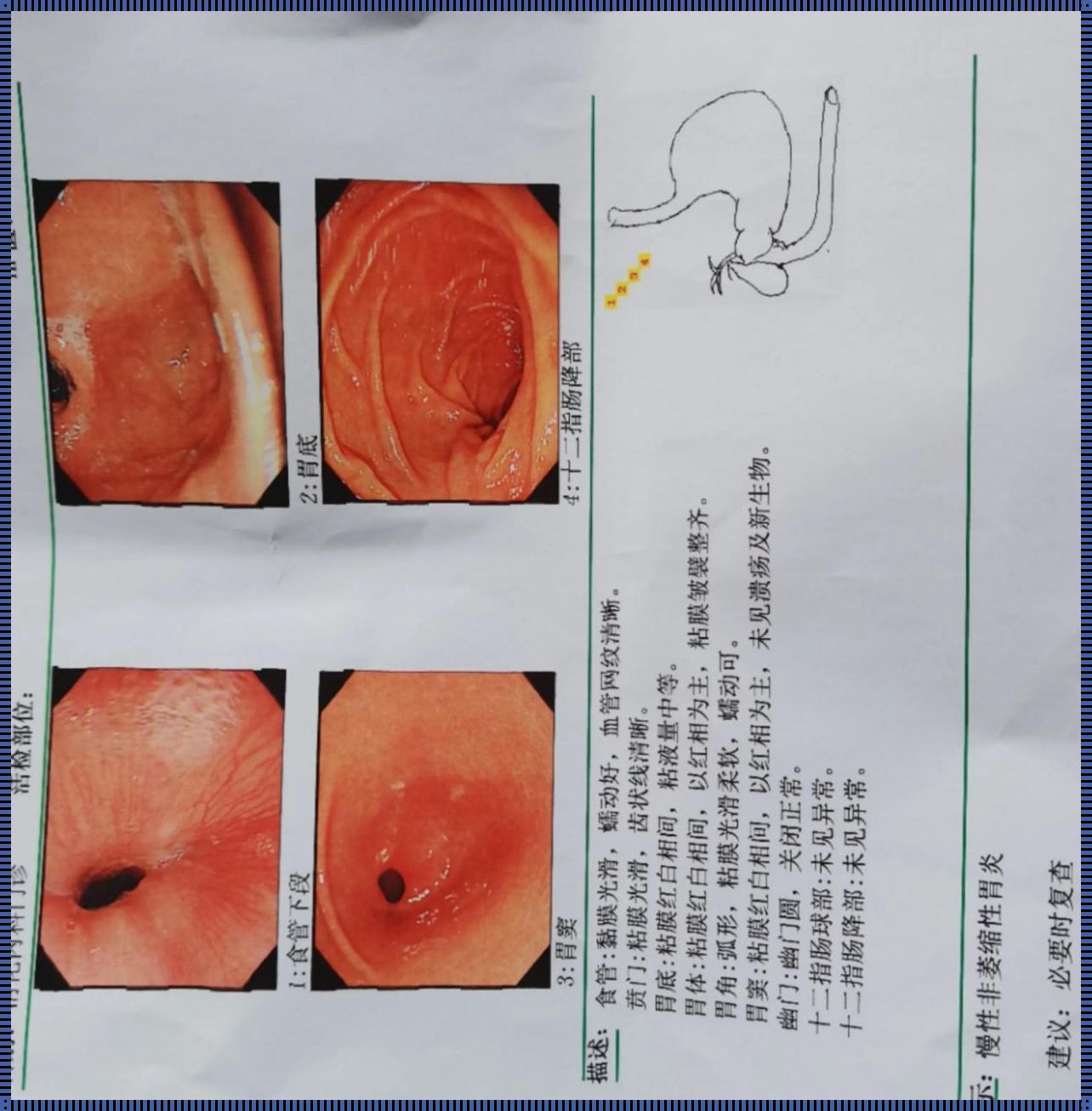 萎缩性胃炎O2什么意思严重吗？深入解析胃部健康隐患