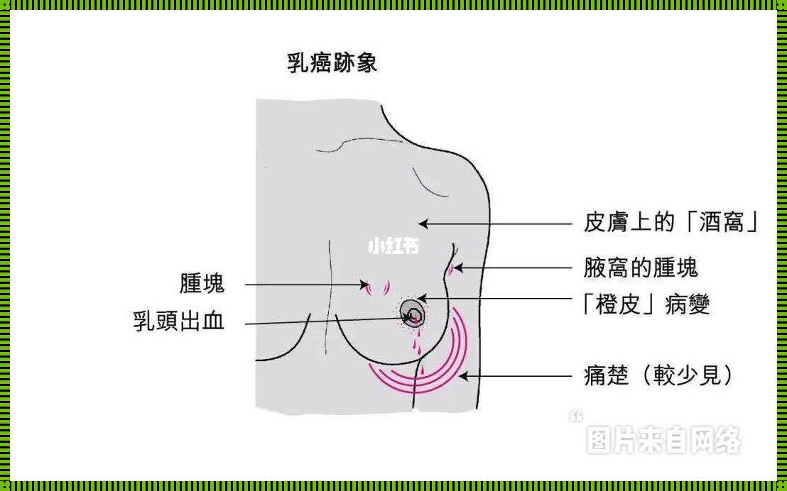 产后不喂奶会乳腺癌吗？