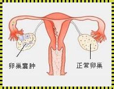 卵巢囊泡：惊现备孕路上的拦路虎