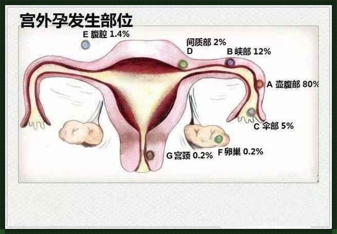 卵巢宫外孕后，还能正常怀孕吗？——以创新玩法备孕