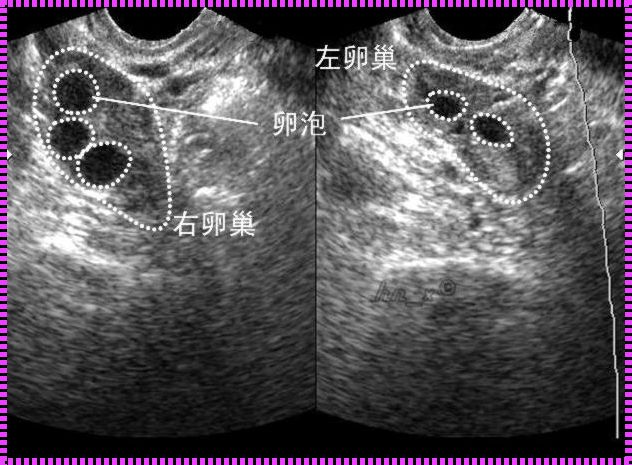 检测卵泡，腹部B超还是阴超——探讨备孕中的推动力量