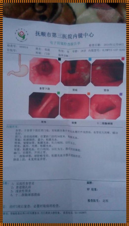 胃病只能做胃镜才能查出来吗——我的亲身经历与感悟