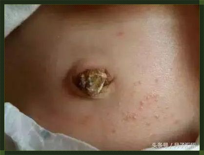 剖腹产后肚脐流脓，一位新手妈妈的困惑与分享