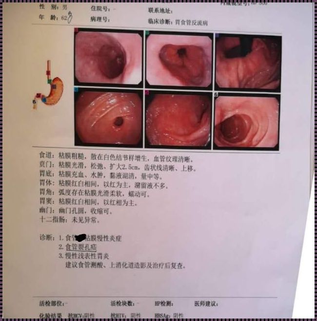 为什么胃镜查不出胃食管反流——一个疑惑者的探索之旅