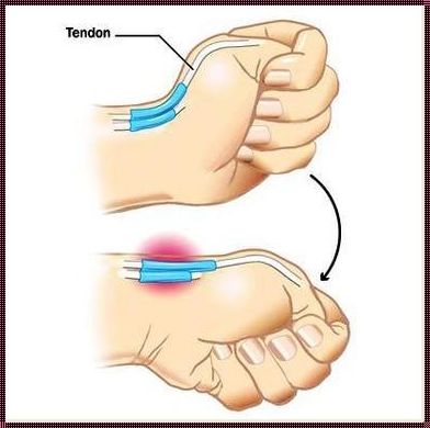 探索腱鞘炎的3个动作自愈方法：我的亲身实践与感悟