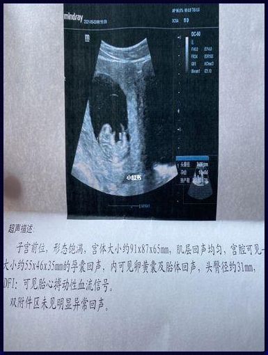 10周胎儿已分男女图：探索生命奥秘的珍贵窗口