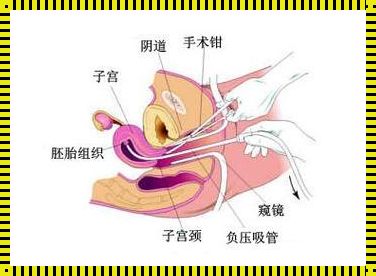 引产后还需要做清宫手术吗？产后揭秘