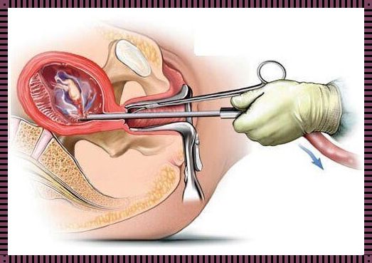 惊现！引产后多揉子宫的奇妙好处