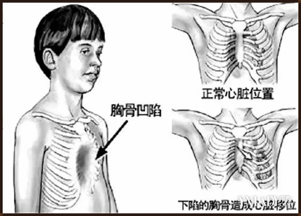 胸凹陷怎么恢复正常——疑难解答