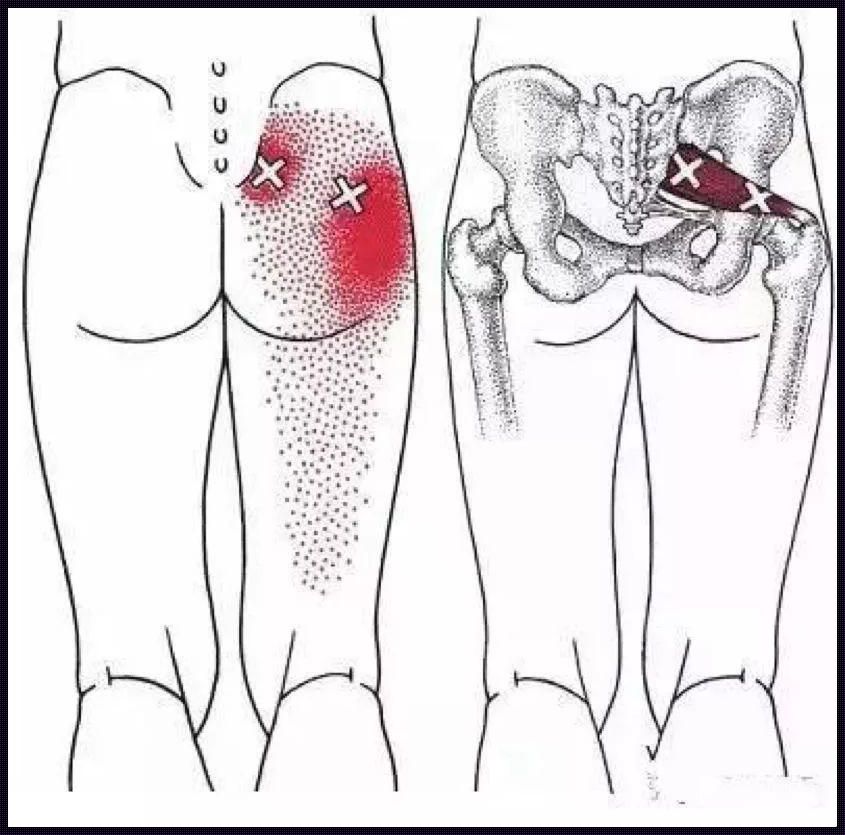 半边屁股酸痛和腿酸疼，揭秘背后的原因及应对策略
