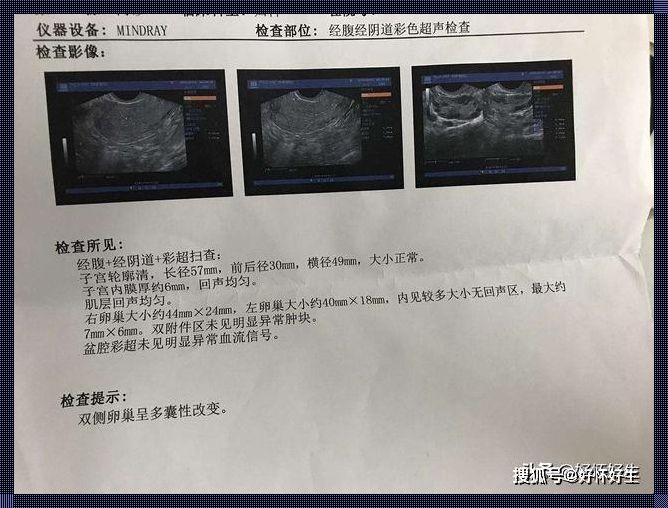 妇科B超能查出多囊卵巢吗？