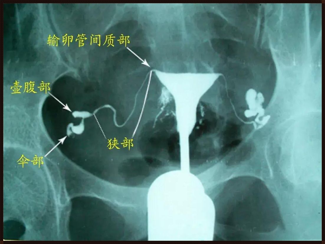 输卵管近端堵塞，探寻疏通的可能